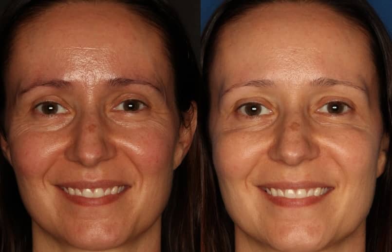 Botox/ Dysport/ Xeomin Gallery Before & After Gallery - Patient 588933 - Image 3