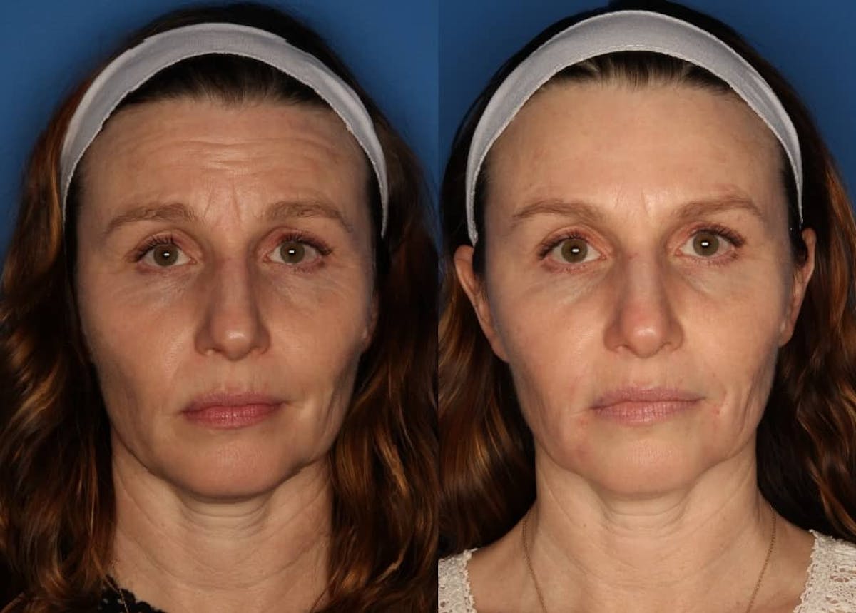 Botox/ Dysport/ Xeomin Gallery Before & After Gallery - Patient 268916 - Image 1