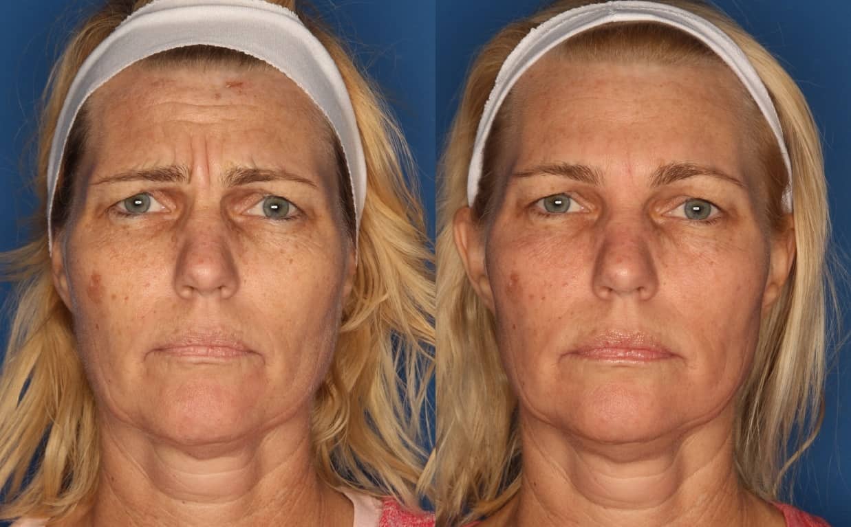 Botox/ Dysport/ Xeomin Gallery Before & After Gallery - Patient 321646 - Image 1