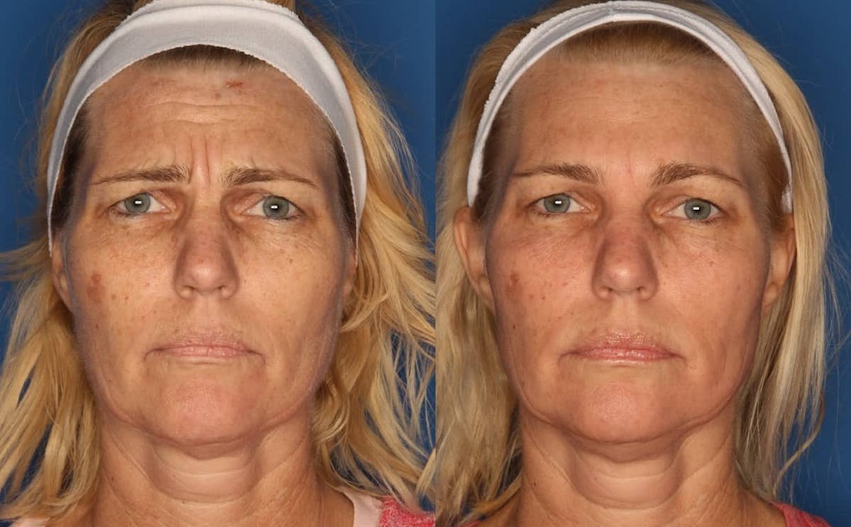 Botox/ Dysport/ Xeomin Before & After Gallery - Patient 321646 - Image 1