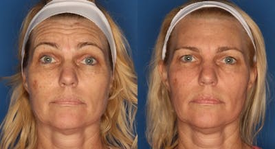 Botox/ Dysport/ Xeomin Gallery Before & After Gallery - Patient 321646 - Image 2