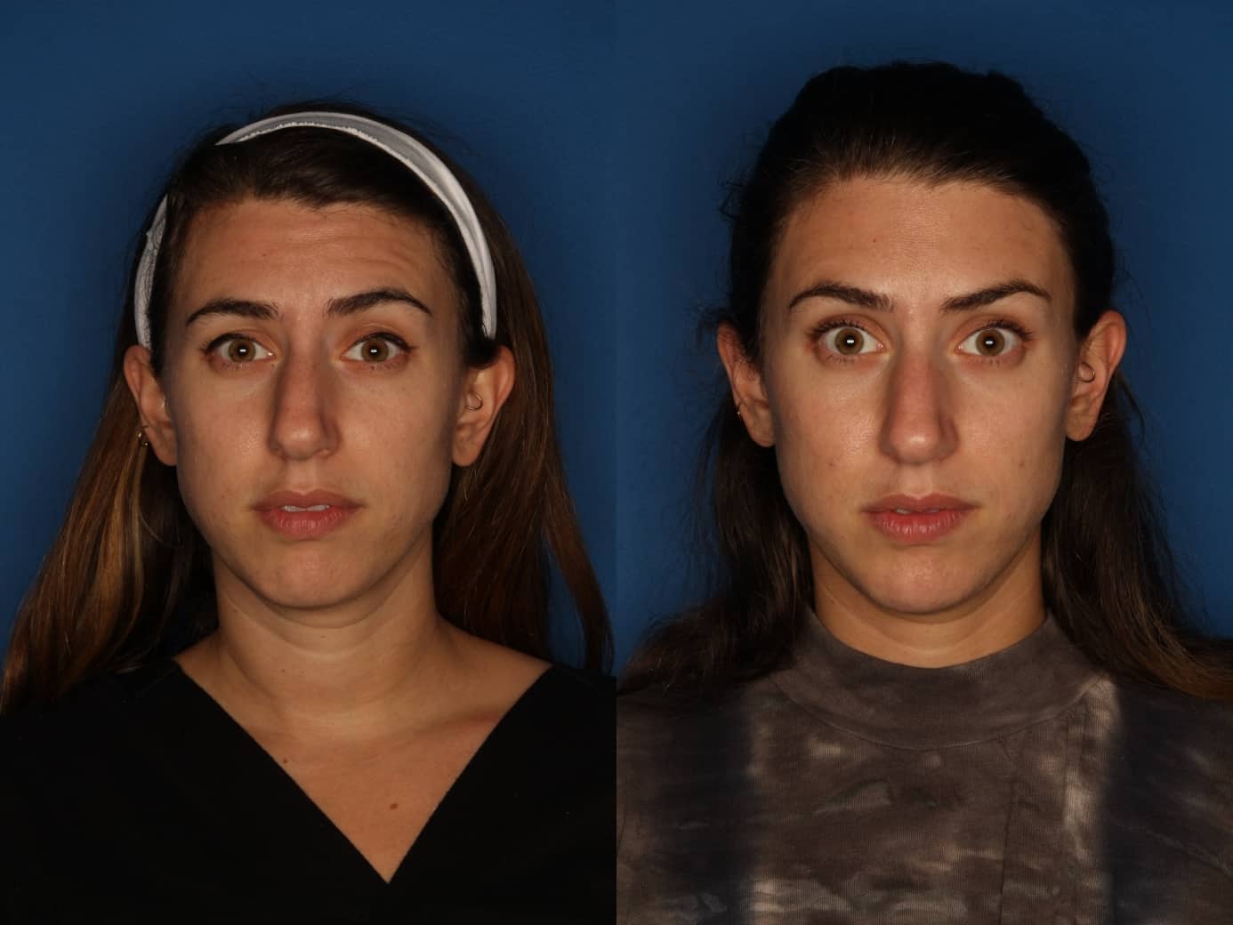 Botox/ Dysport/ Xeomin Before & After Gallery - Patient 172514 - Image 1