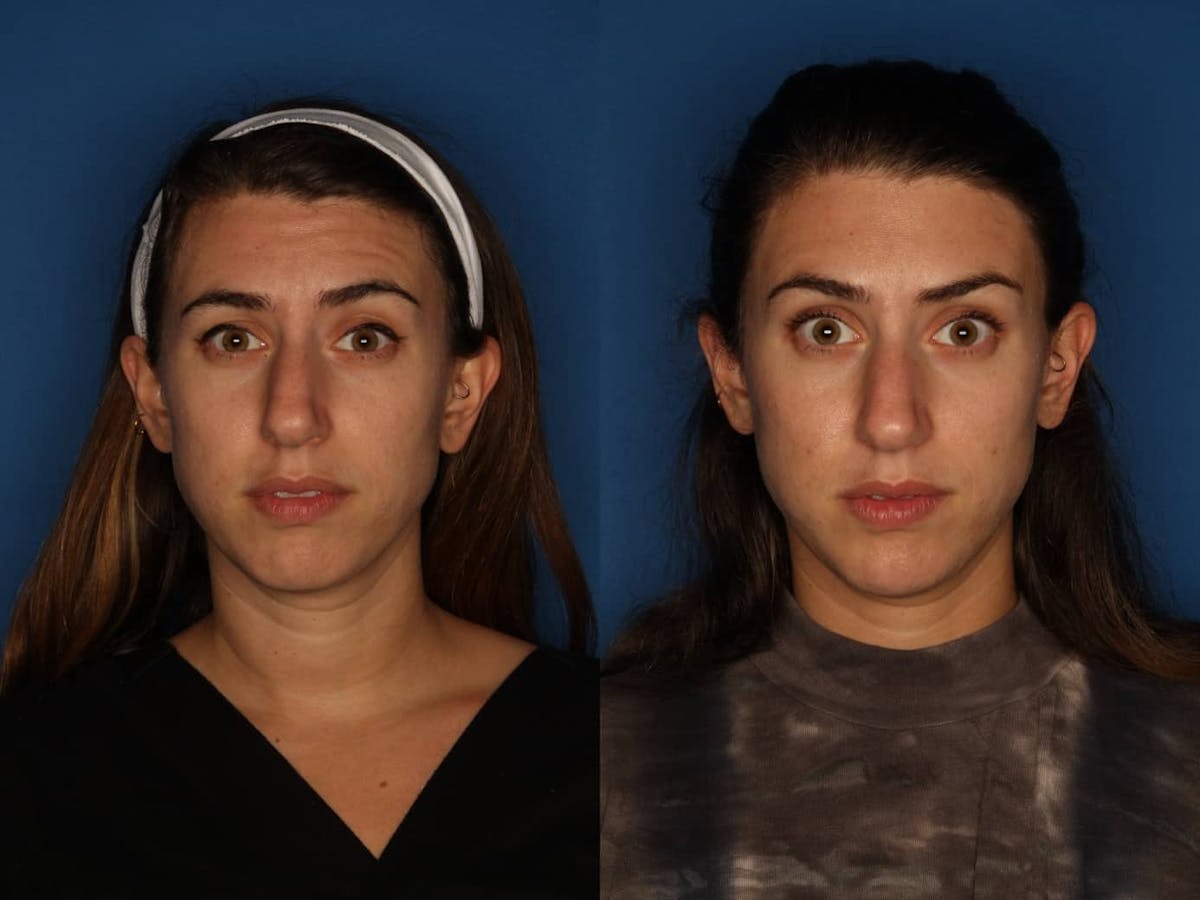 Botox/ Dysport/ Xeomin Gallery Before & After Gallery - Patient 172514 - Image 1