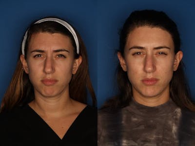 Botox/ Dysport/ Xeomin Before & After Gallery - Patient 172514 - Image 2