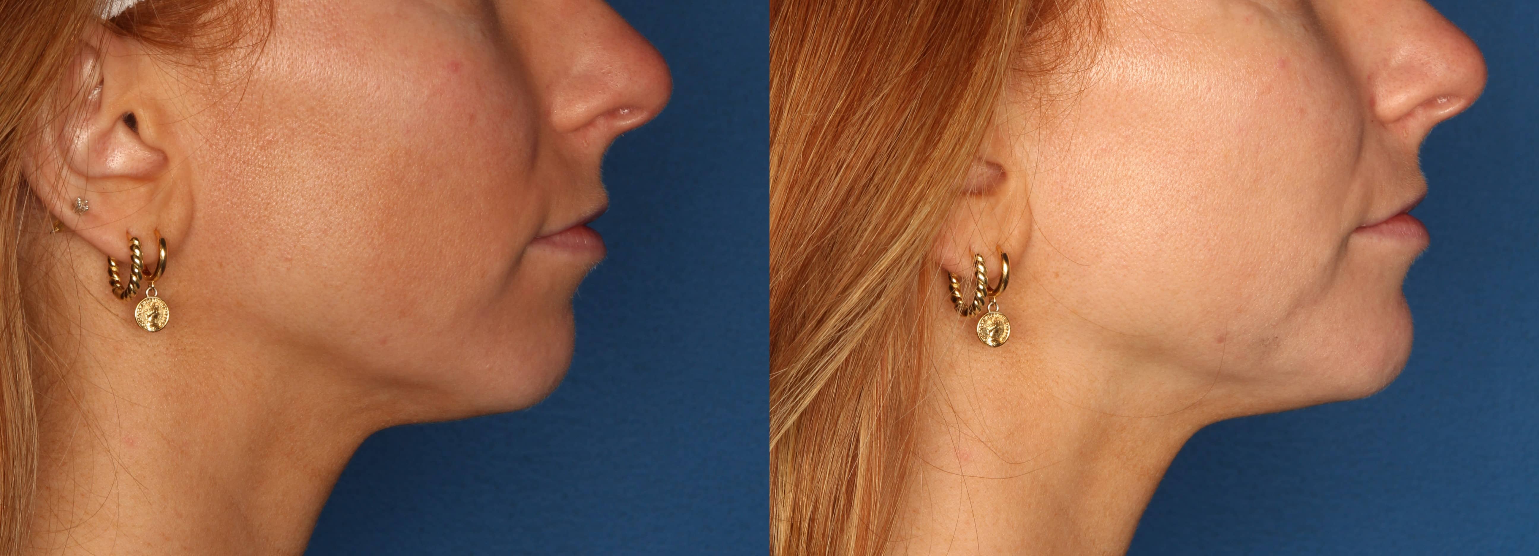 Chin Augmentation Before & After Gallery - Patient 263697 - Image 1
