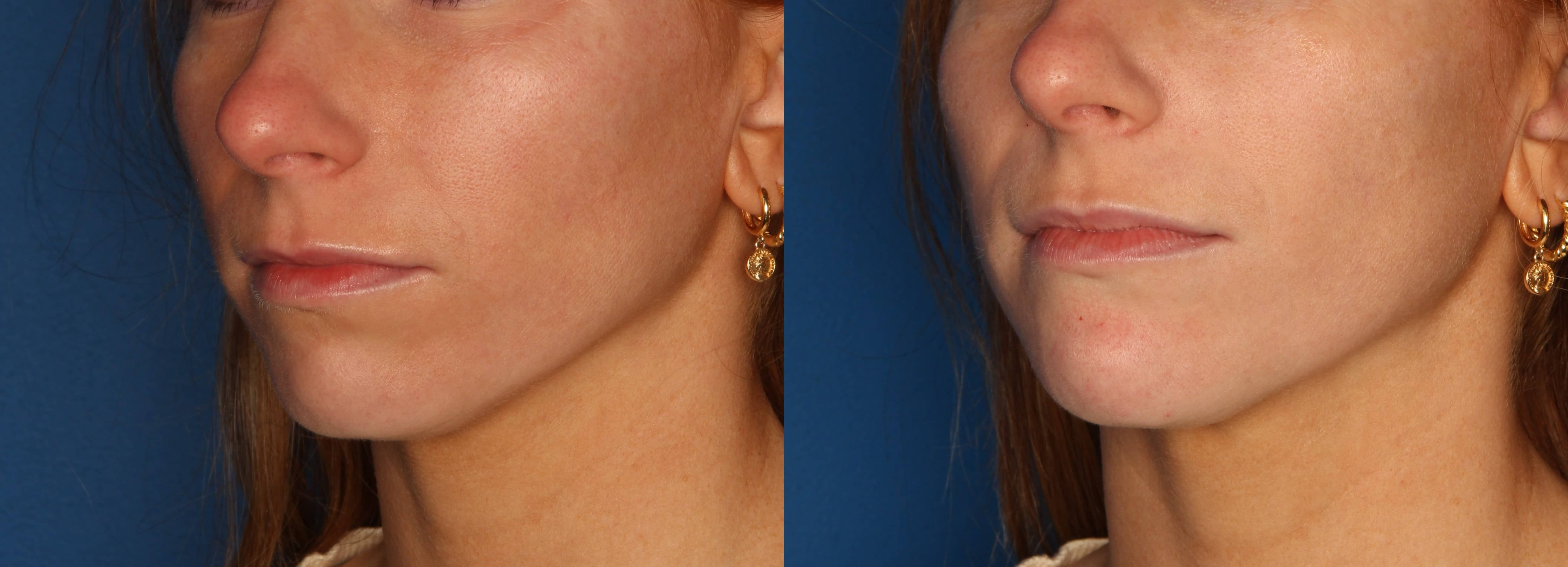 Chin Augmentation Before & After Gallery - Patient 263697 - Image 2