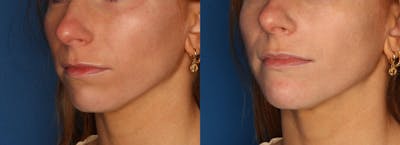 Chin Augmentation Gallery Before & After Gallery - Patient 263697 - Image 2