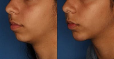 Chin Augmentation Before & After Gallery - Patient 309225 - Image 2