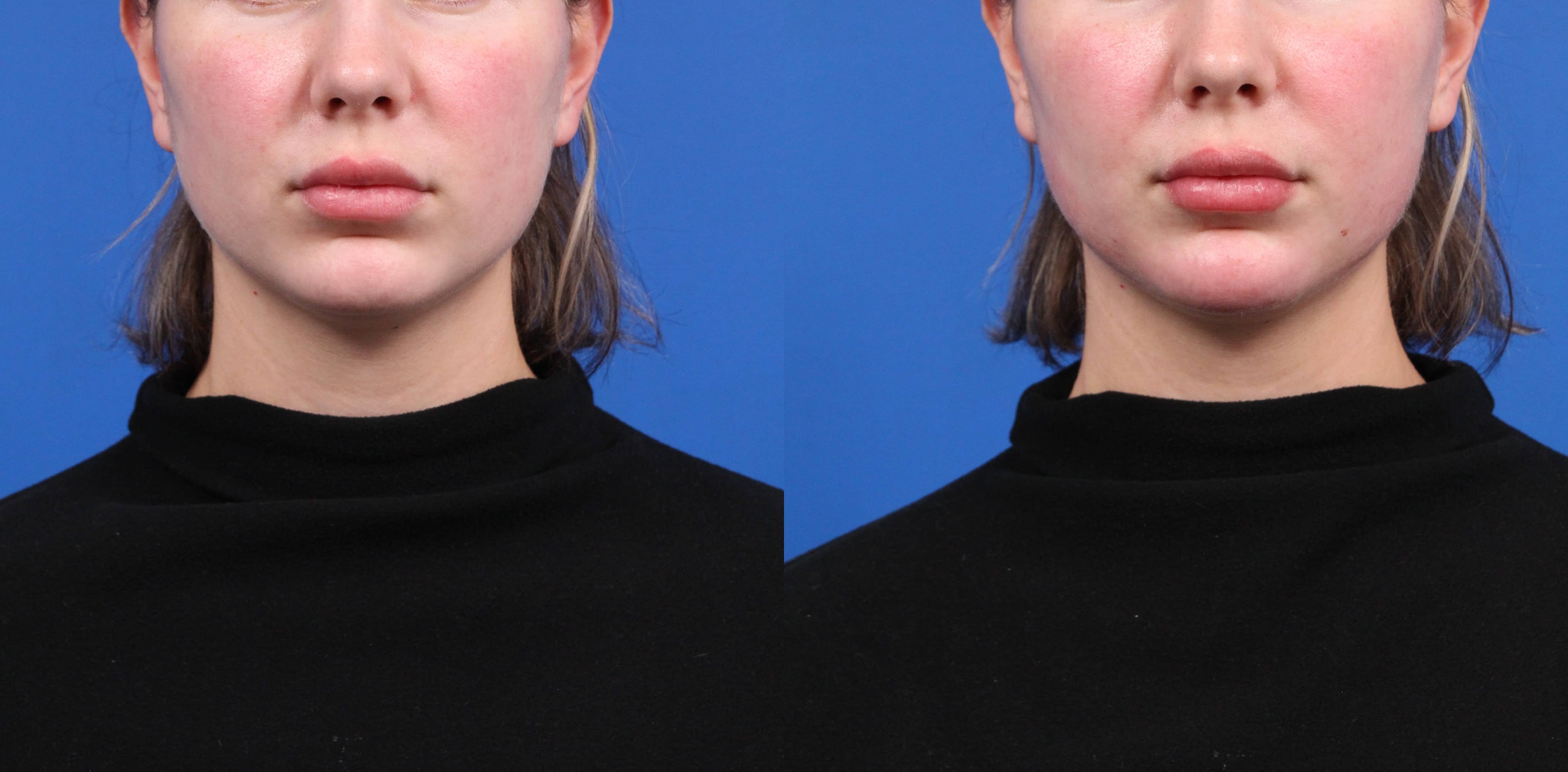 Chin Augmentation Before & After Gallery - Patient 234403 - Image 1