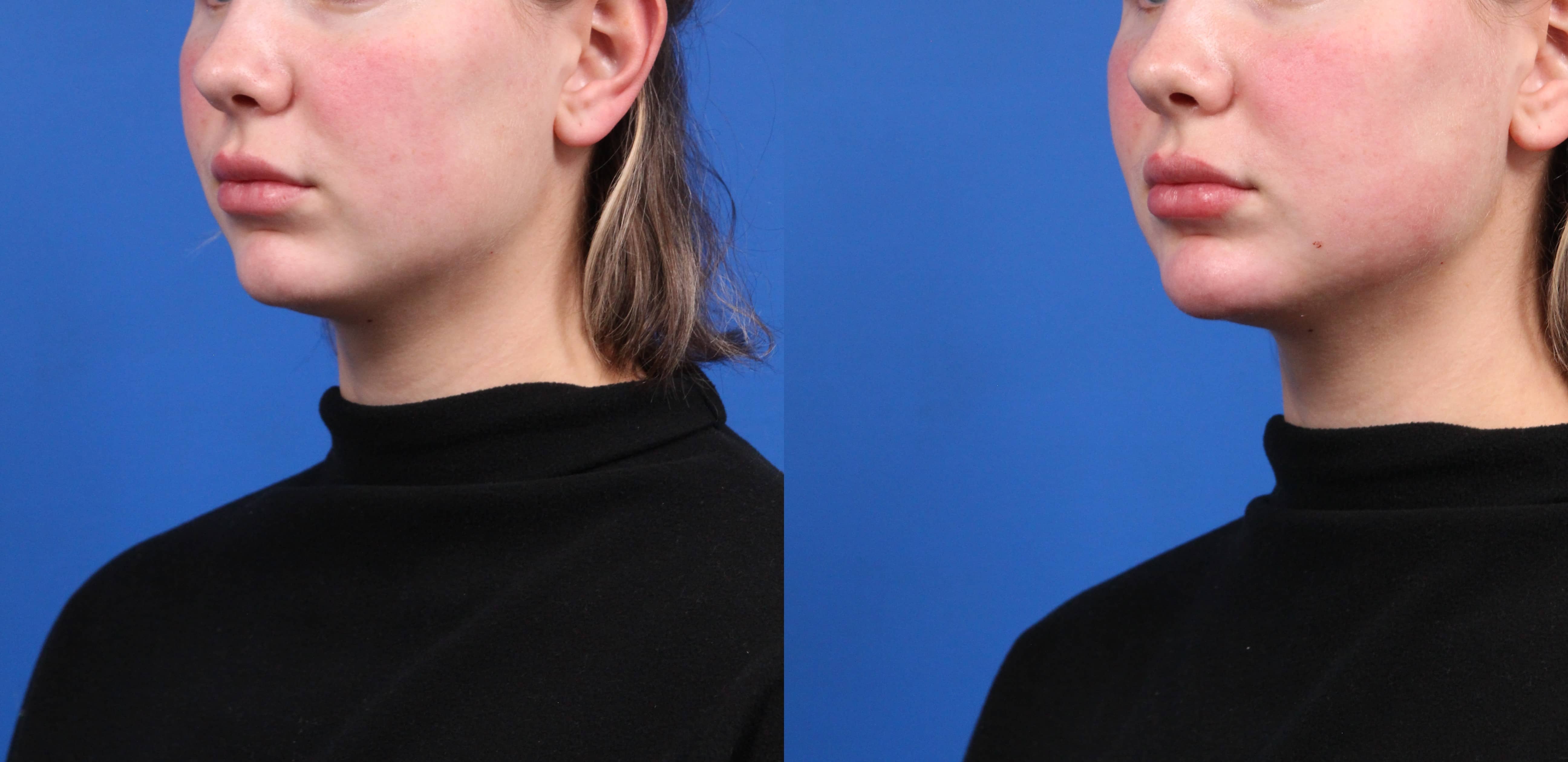 Dermal Fillers Before & After Gallery - Patient 387290 - Image 2