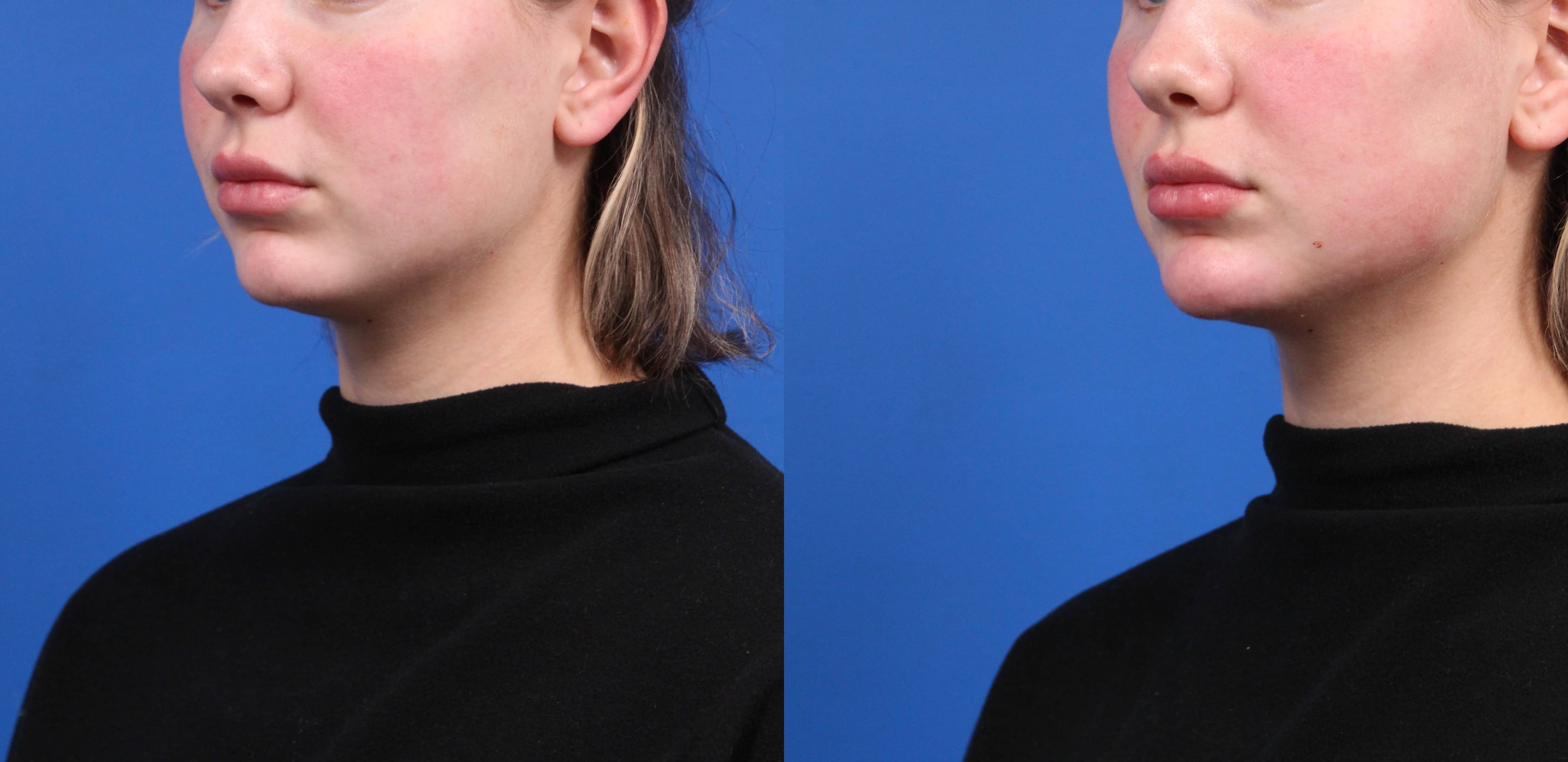 Chin Augmentation Gallery Before & After Gallery - Patient 234403 - Image 2