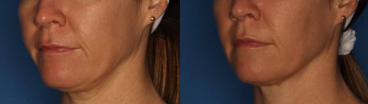 Dermal Fillers Before & After Gallery - Patient 422708 - Image 1