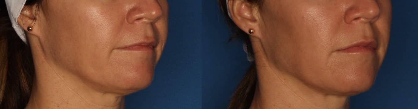 Dermal Fillers Before & After Gallery - Patient 422708 - Image 2