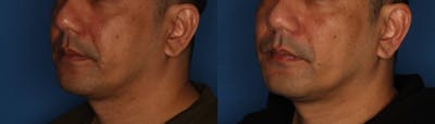 Dermal Fillers Gallery Before & After Gallery - Patient 739477 - Image 2