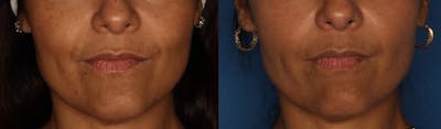 Dermal Fillers Gallery Before & After Gallery - Patient 103238 - Image 1