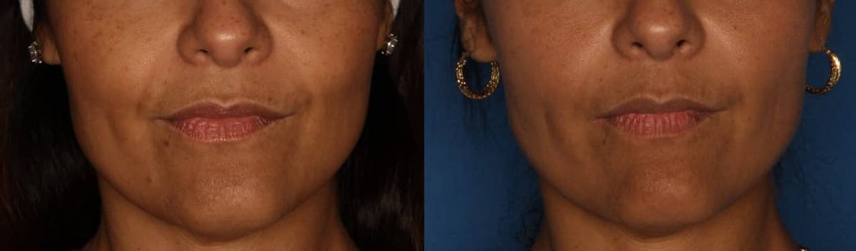 Dermal Fillers Gallery Before & After Gallery - Patient 103238 - Image 1