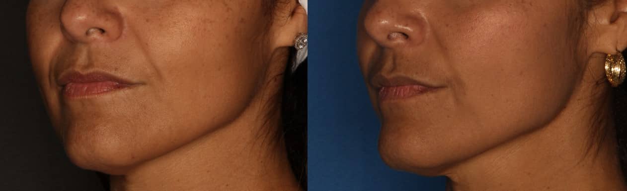 Dermal Fillers Before & After Gallery - Patient 103238 - Image 2
