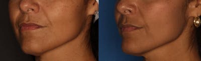 Dermal Fillers Gallery Before & After Gallery - Patient 103238 - Image 2