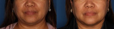 Dermal Fillers Gallery Before & After Gallery - Patient 864862 - Image 1