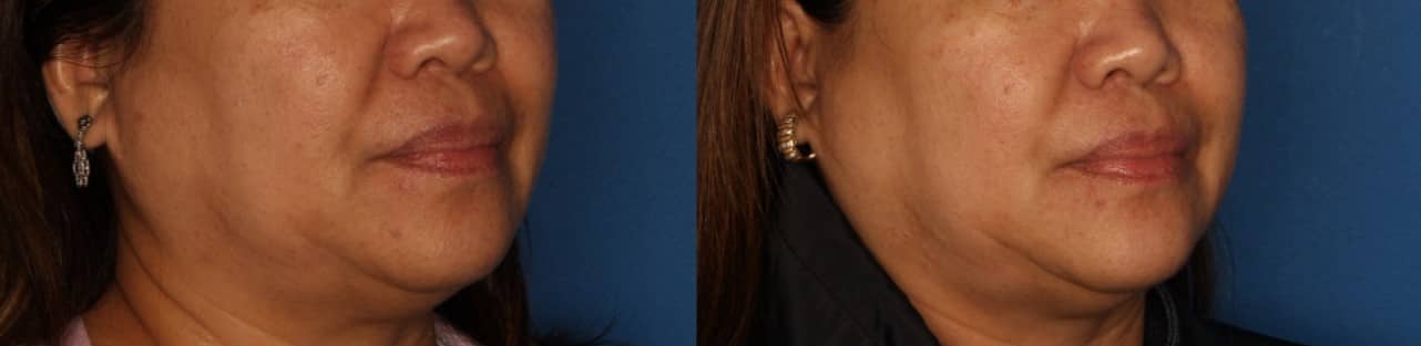 Dermal Fillers Before & After Gallery - Patient 864862 - Image 2
