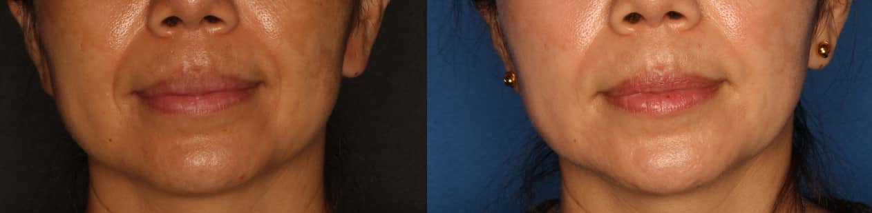 Dermal Fillers Before & After Gallery - Patient 249056 - Image 1