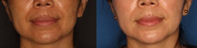 Dermal Fillers Gallery Before & After Gallery - Patient 249056 - Image 1