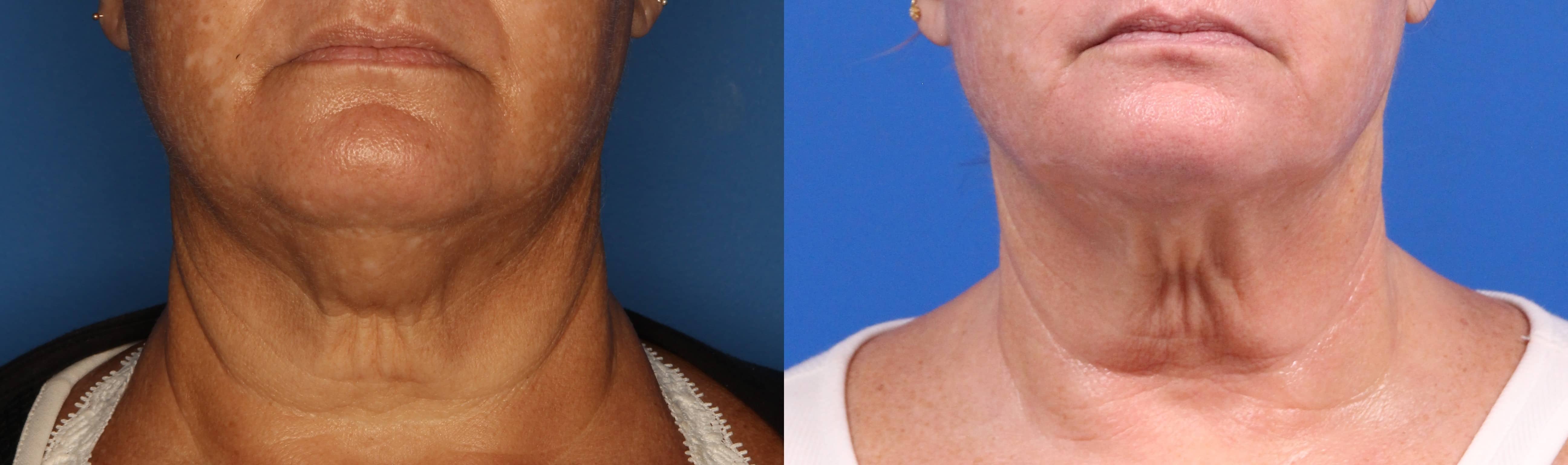 Kybella Gallery Before & After Gallery - Patient 905340 - Image 1