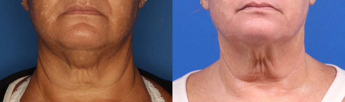 Kybella Gallery Before & After Gallery - Patient 905340 - Image 1