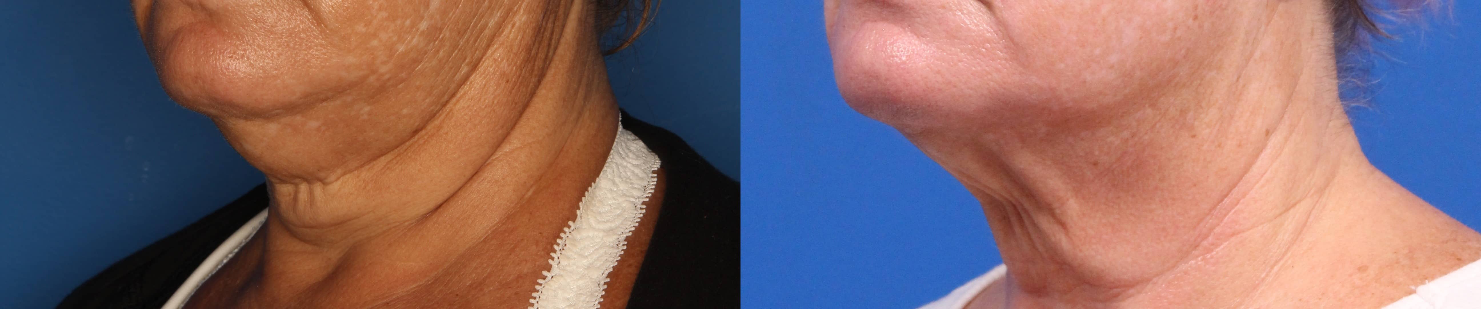 Kybella Gallery Before & After Gallery - Patient 905340 - Image 2