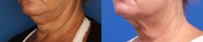 Kybella Gallery Before & After Gallery - Patient 905340 - Image 2