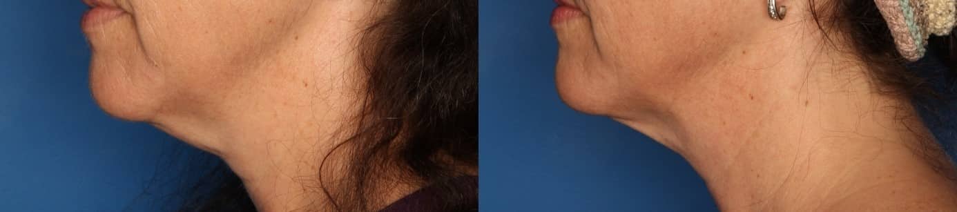 Kybella Gallery Before & After Gallery - Patient 415795 - Image 2