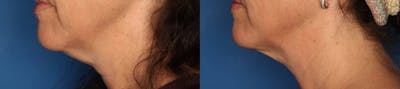 Kybella Gallery Before & After Gallery - Patient 415795 - Image 2