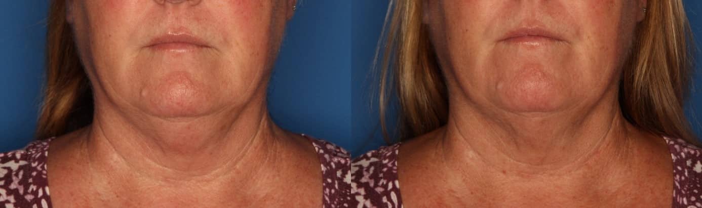 Kybella Before & After Gallery - Patient 211832 - Image 1