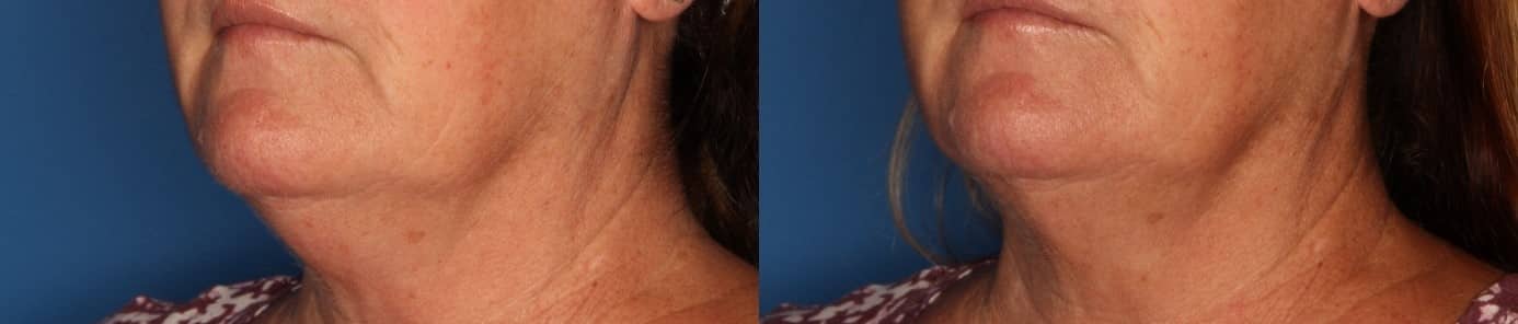 Kybella Before & After Gallery - Patient 211832 - Image 2