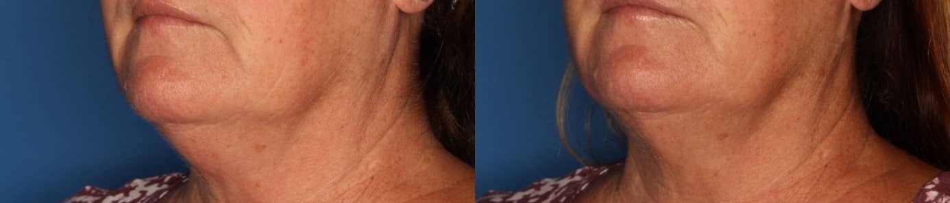 Kybella Gallery Before & After Gallery - Patient 211832 - Image 2