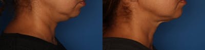 Kybella Before & After Gallery - Patient 189353 - Image 1