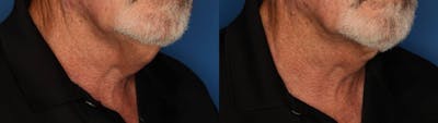 Kybella Gallery Before & After Gallery - Patient 195435 - Image 2