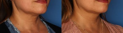 Before and After