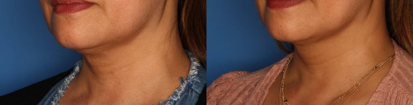 Kybella Before & After Gallery - Patient 174380 - Image 2