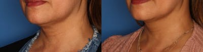 Kybella Gallery Before & After Gallery - Patient 174380 - Image 2