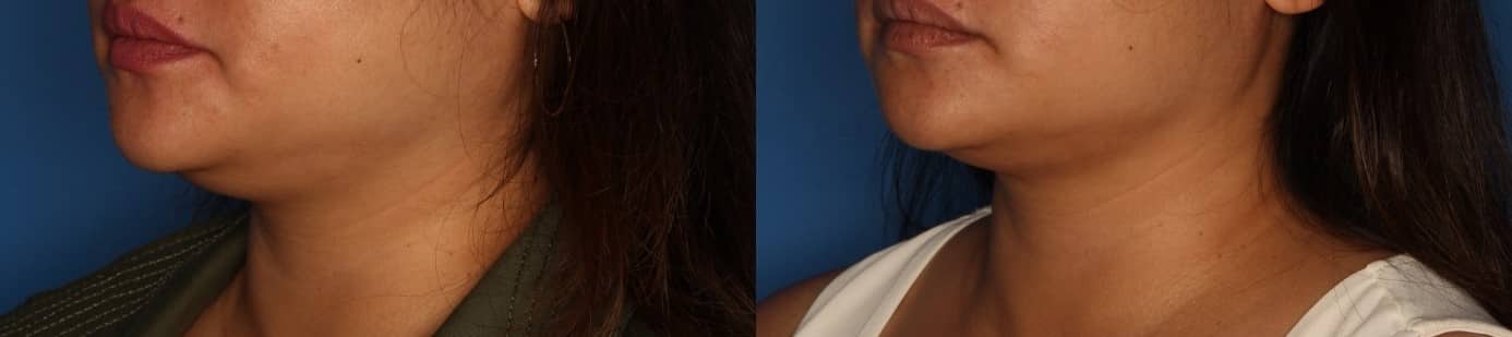 Kybella Before & After Gallery - Patient 287827 - Image 1