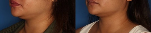 Before and After