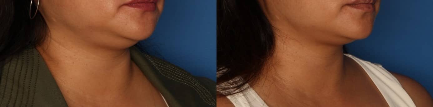Kybella Before & After Gallery - Patient 287827 - Image 2
