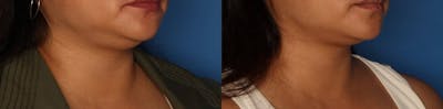 Kybella Gallery Before & After Gallery - Patient 287827 - Image 2