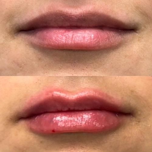 Cupids Bow Lip Filler: A Guide To Perfect Lips