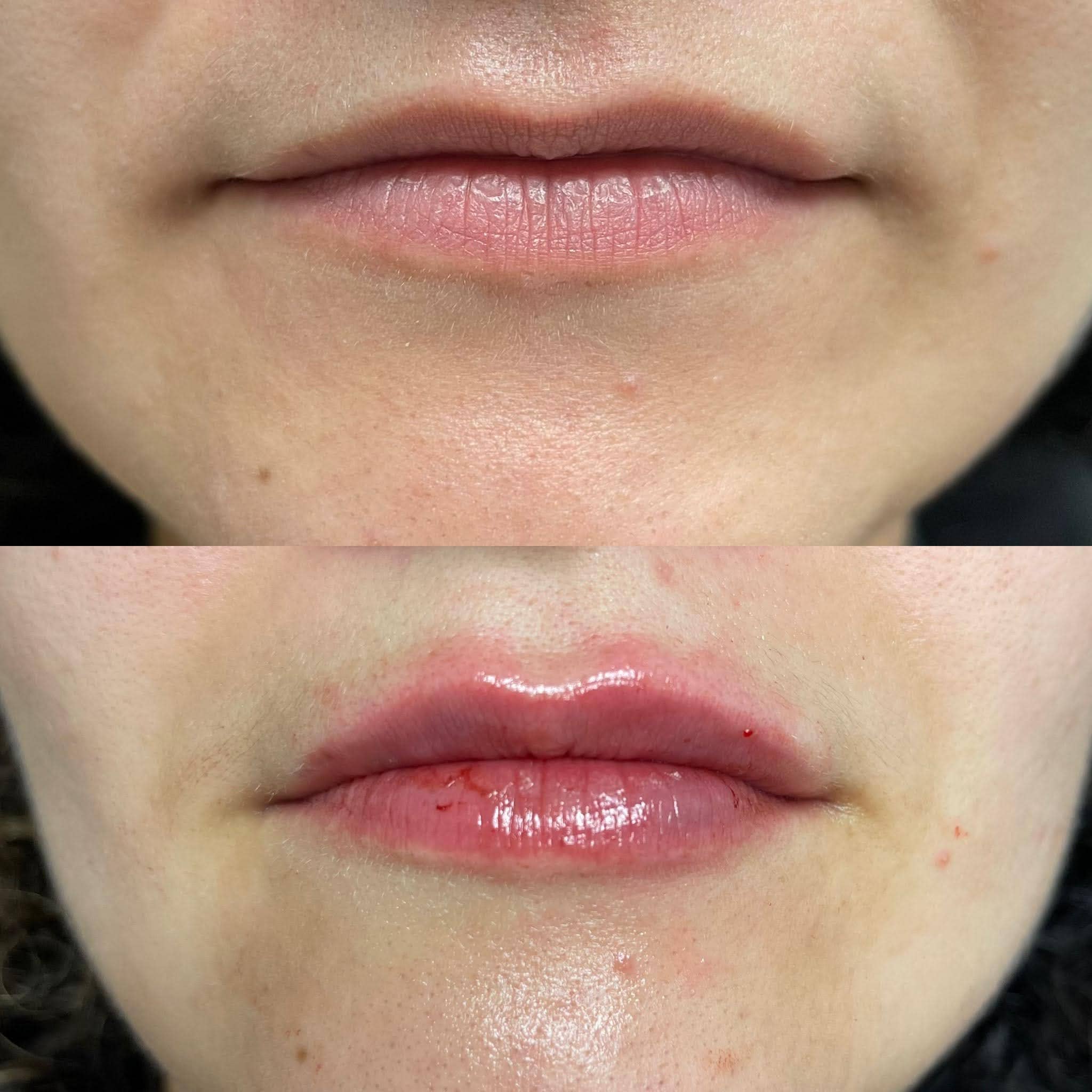 Lip Augmentation Before & After Gallery - Patient 381549 - Image 1