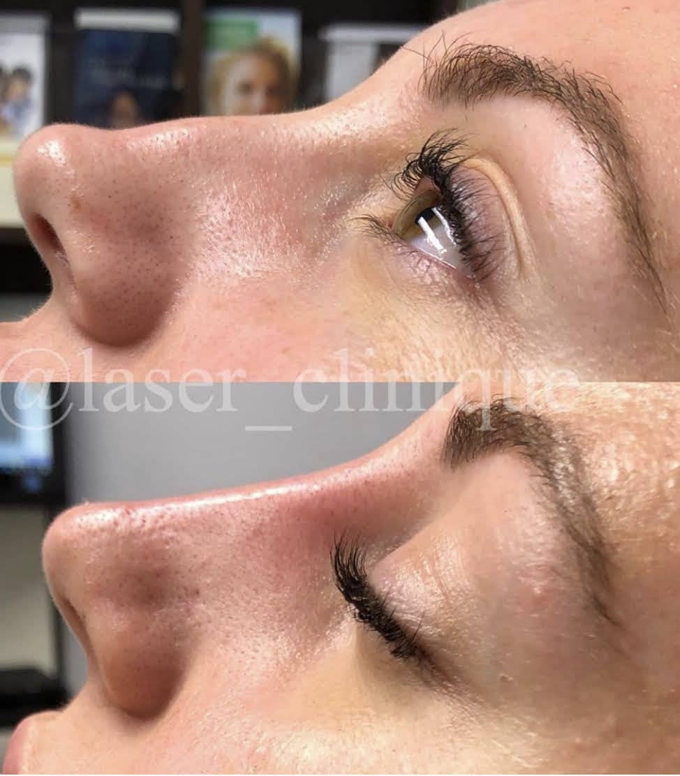 Non-Surgical Rhinoplasty Before & After Gallery - Patient 143466 - Image 1