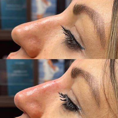 Non-Surgical Rhinoplasty Before & After Gallery - Patient 372398 - Image 1