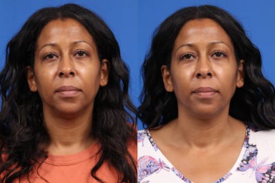 Tear Trough Augmentation Gallery Before & After Gallery - Patient 121663 - Image 1