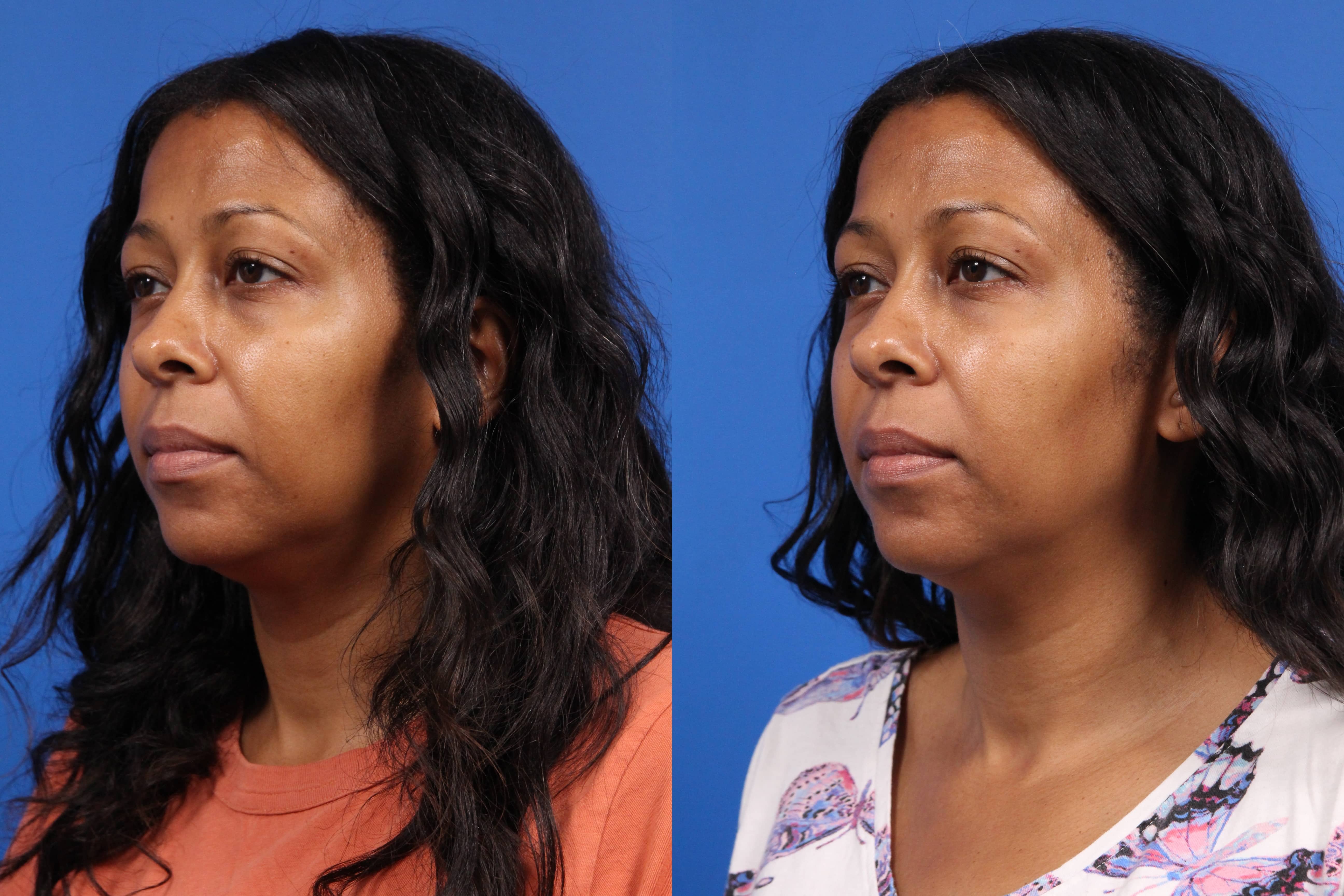 Tear Trough Augmentation Before & After Gallery - Patient 121663 - Image 2